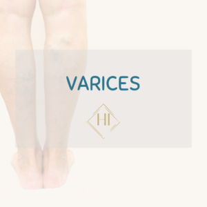 baja laboral por varices